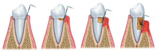Gingivitis – parodontitis: mírná – stření – pokročilá